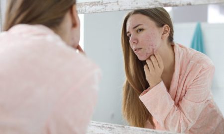 Dairy Leads to Acne
